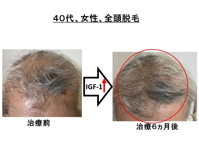 円形脱毛症　病院